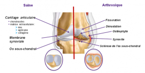 arthrose, ostéopathie