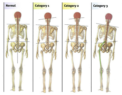 bilan postural, posturologie, ostéopathie, le luc, gary monfort